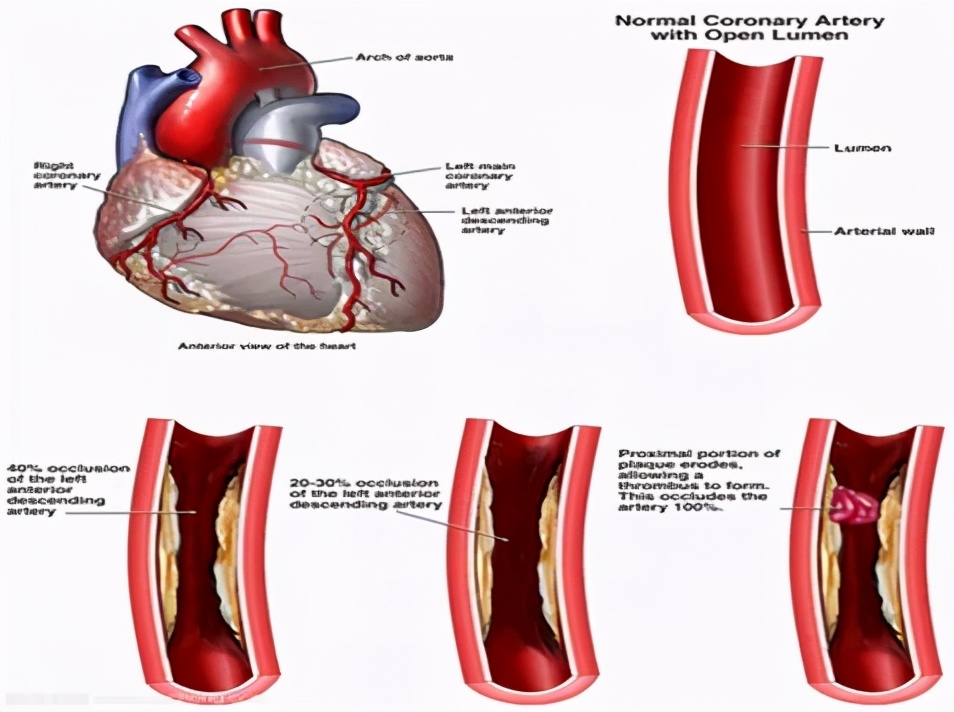 冠心病算大病吗为什么会得冠心病,冠心病的原因冠心病是怎么引起的