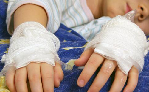 孩子被烫伤紧急急救,小儿意外烫伤要如何急救