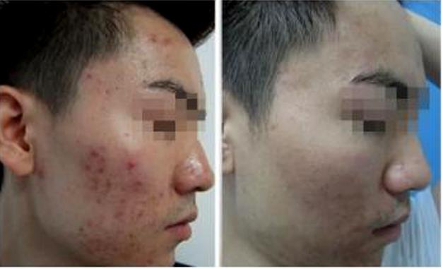 痘肌精华推荐祛痘印学生,油痘肌好用的祛痘精华推荐