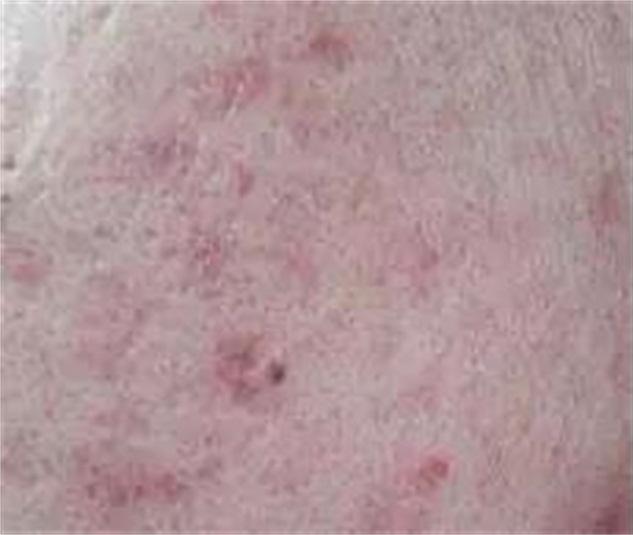 痘印严重到底怎么办,毁容式痘痘有什么办法消除