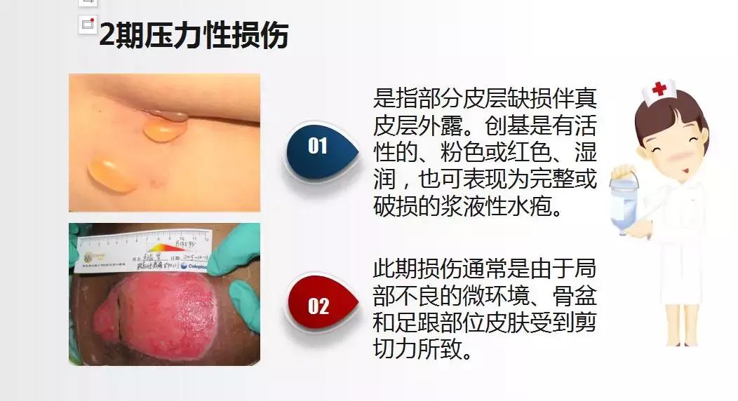 面对压疮不要慌,护理小妙招帮你忙!