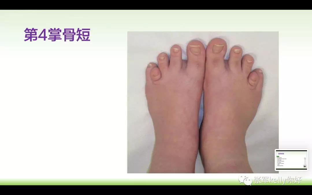 Turner综合征的指南学习