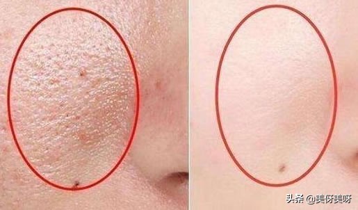 长黑头的原因和改善方法,黑头前面长出了白头怎么去掉