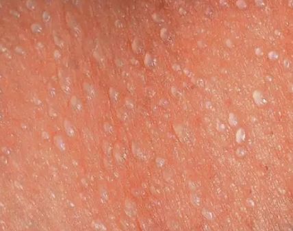 宝宝长痱子用什么方法最好,如何防止宝宝长痱子更有效