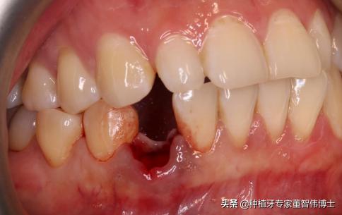 全冠修复与种植区别,全口即刻种植修复详细流程介绍