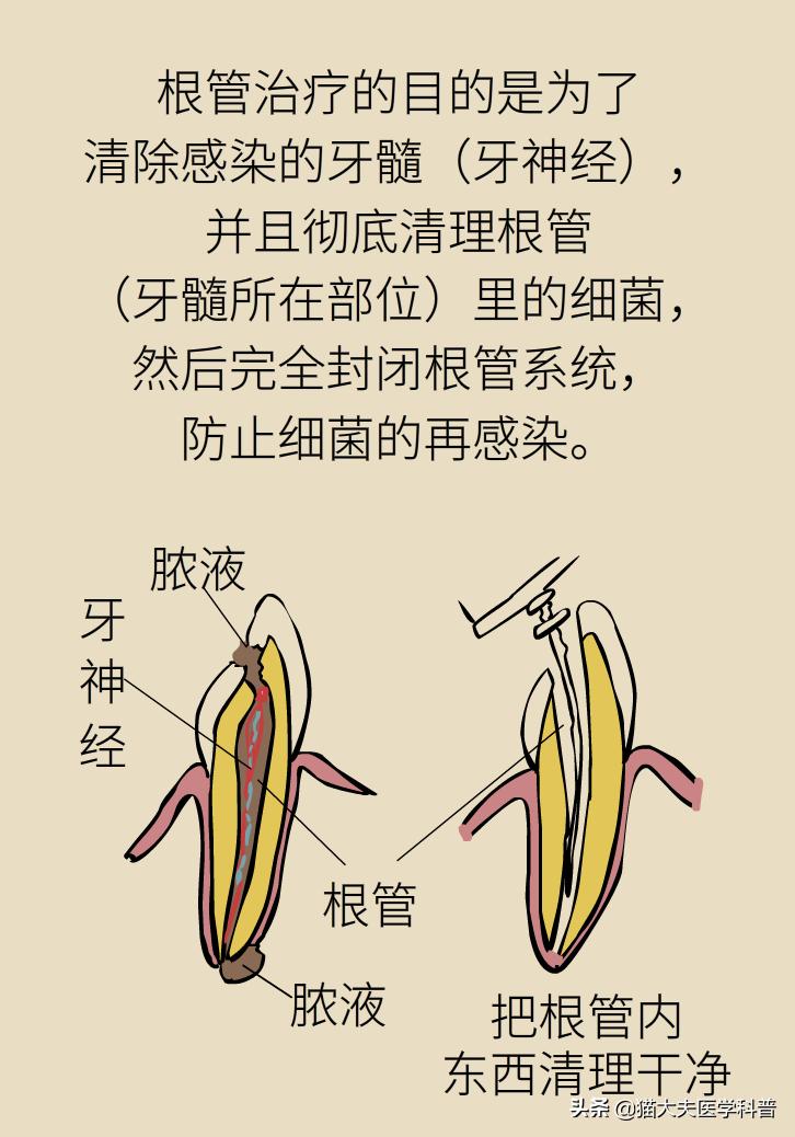 杀死牙神经变成死牙了吗,杀牙神经到底好不好