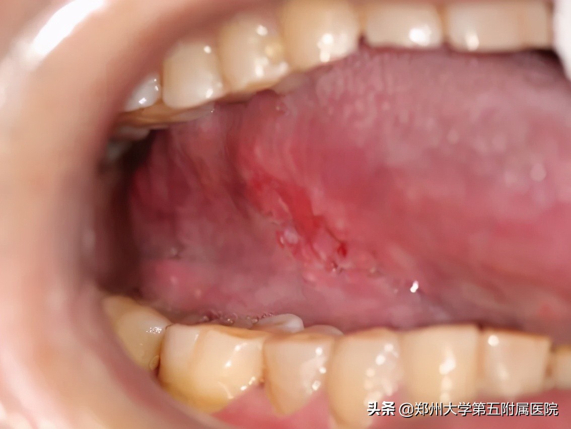 有一种痛叫口腔溃疡图片卡通,口腔溃疡痛用什么药