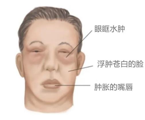 【慎之又肾】经常自我感觉“膨胀”？你可能是肿了