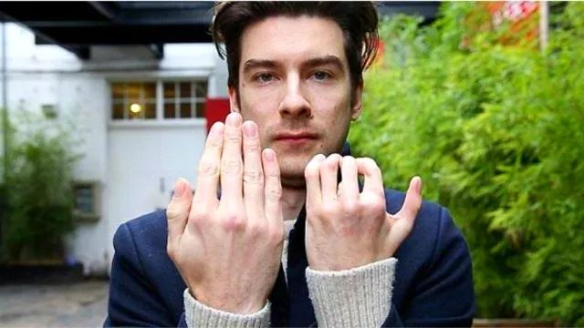 外国帅哥患波兰综合症，移植脚趾到手上，网友表示：看脸就行！