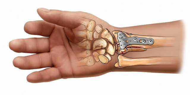 骨折复位后又移位有什么症状,骨折手法复位后容易移位吗