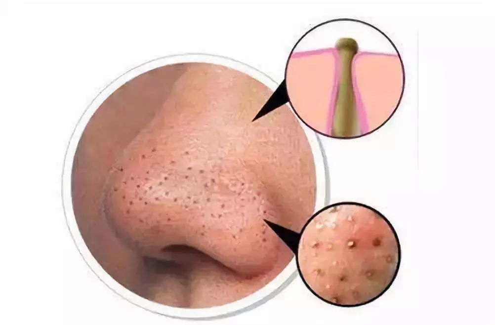 9岁脸上长黑头粉刺怎么去掉,鼻子上的黑头粉刺到底能不能去掉