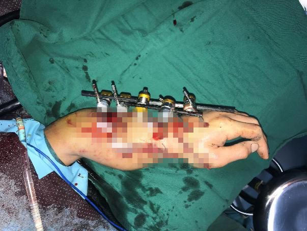 深圳市第二人民医院手足外科拯救东莞断臂伤者医生提醒--断肢千万不要泡水里！