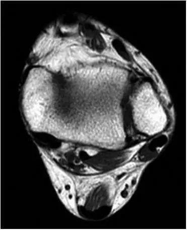 踝关节撞击症问诊,踝关节撞击综合征的x线表现