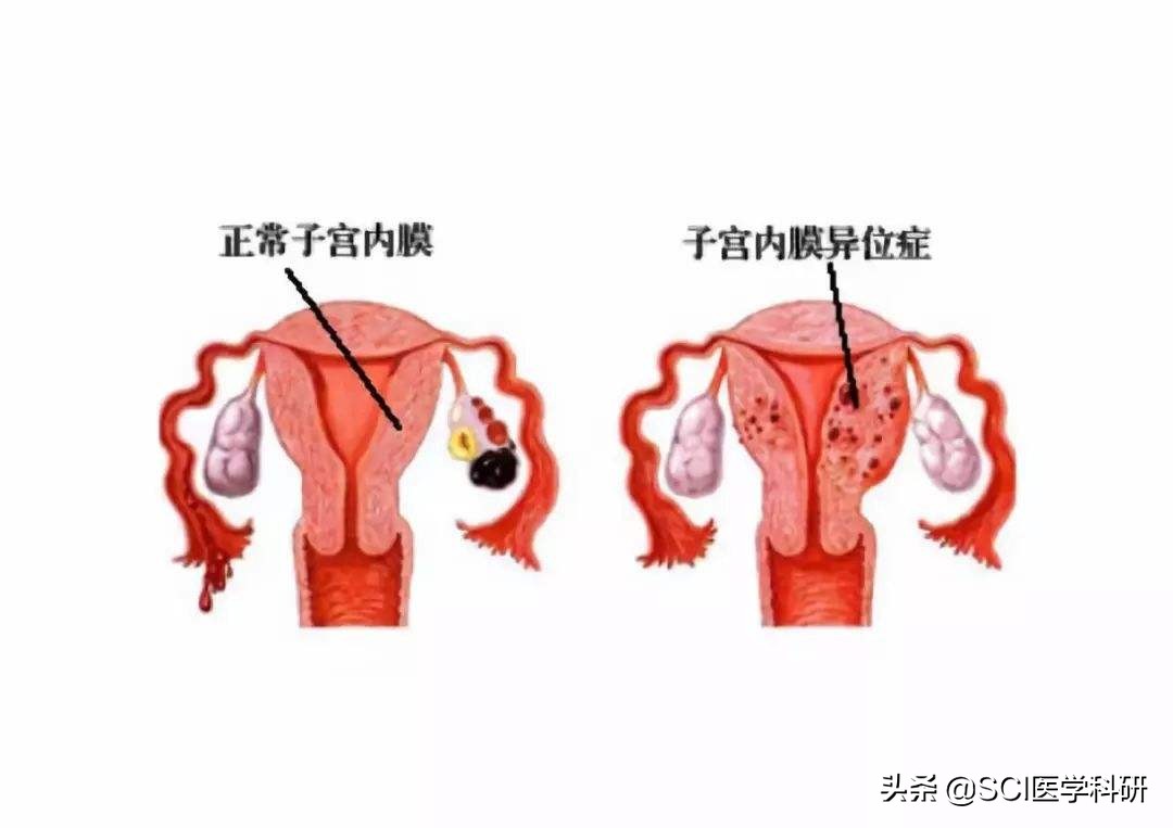 子宫内膜异位症治疗新进展,子宫内膜异位症已做了病灶去除