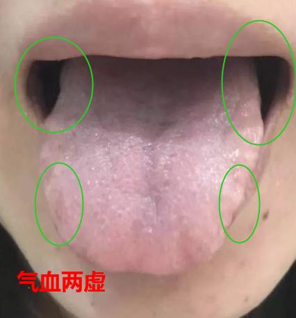 脾气虚和脾阳虚脾虚湿盛的区别,脾虚百病生脾虚有哪些表现