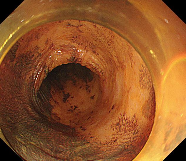 胃镜下黏膜剥离手术护理,内镜黏膜下肿瘤剥离术