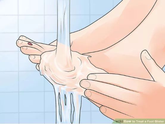 如何预防与处理比跑步膝痛还烦人的水泡？