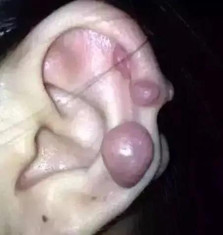 耳垂长个肉疙瘩是怎么回事,耳垂肉长了硬疙瘩怎么回事