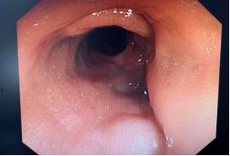 肠穿孔非手术治疗措施,结肠穿孔治疗视频