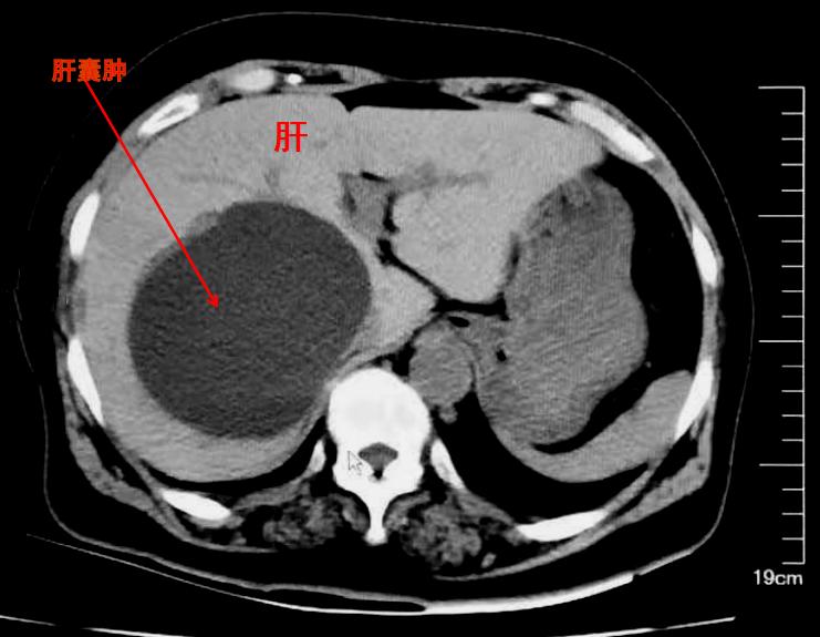 肿块一定是癌症吗,肿块是肿瘤吗