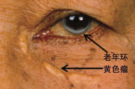 高血脂会导致血脂高吗,高血脂与血脂高是一样吗