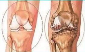 骨质增生和骨关节炎补钙有用吗,骨刺骨质增生关节炎用什么药