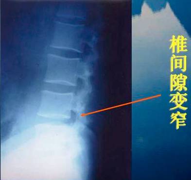 腰椎间盘突出症的临床诊治策略,腰椎间盘突出症的临床诊治