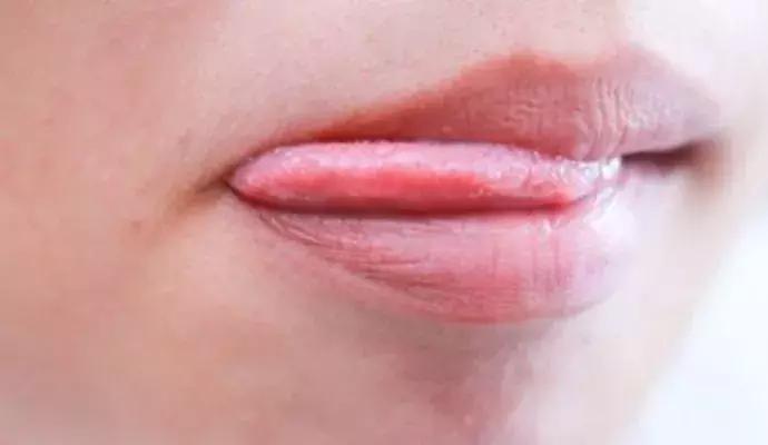 嘴唇干爆皮唇炎用什么药膏,唇炎一直嘴唇干裂起皮什么原因