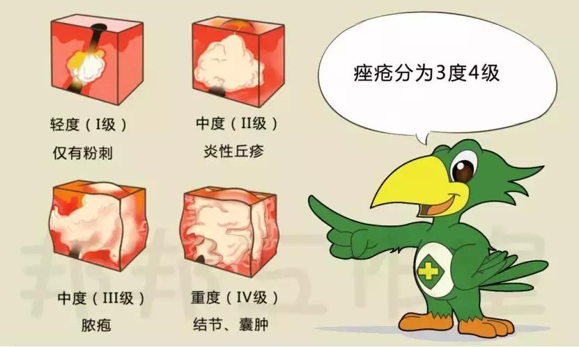 白头黑头粉刺怎么消除,长黑头粉刺的正确消除方法