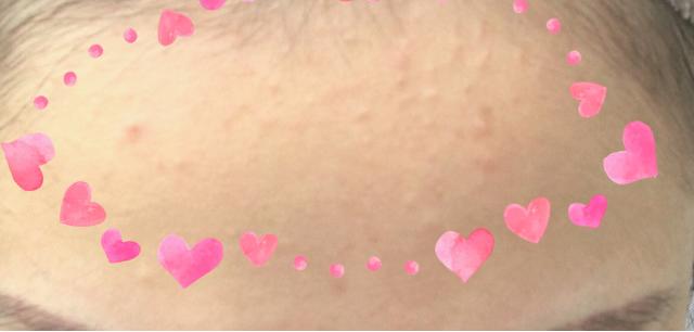 30多岁了脸上还是长痘痘反反复复,脸上反反复复长痘痘是怎么回事