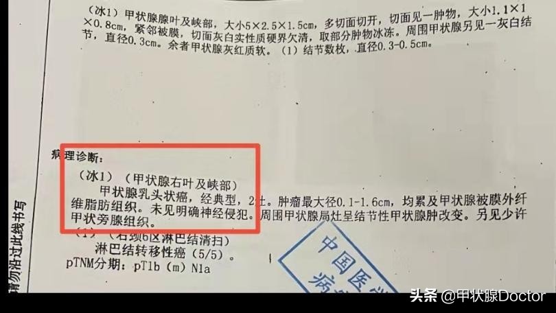 甲癌42个淋巴结颈部转移能活几年,甲癌颈部淋巴结转移41颗能活多久