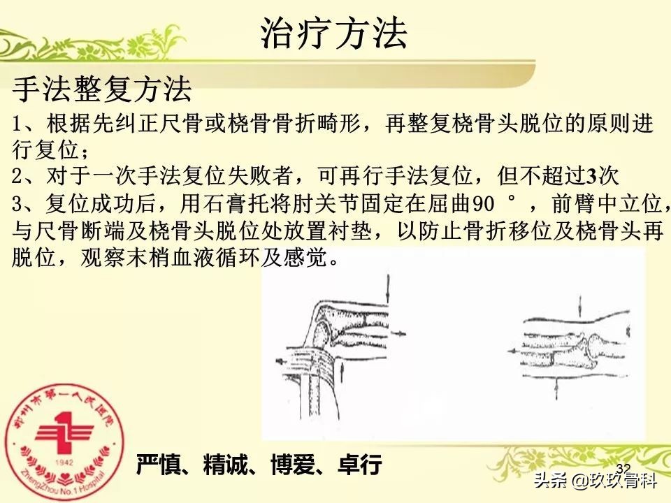 孟氏骨折功能训练多久能恢复正常,孟氏骨折中医能治吗