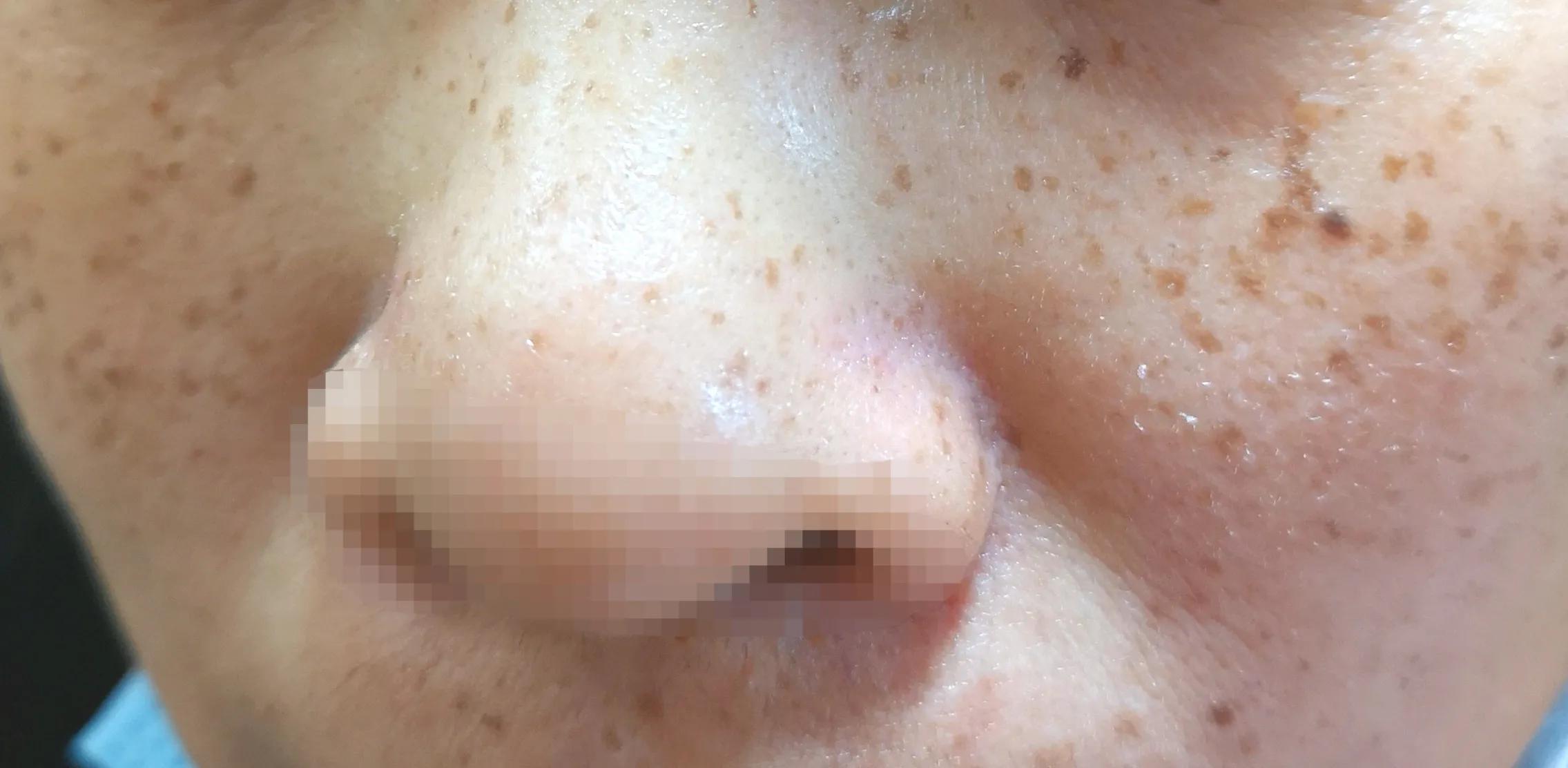 脸上各种斑图解,脸上常见6种斑点图片