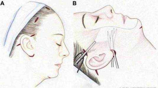 拉皮术除皱后会衰老更快吗,做拉皮手术后皮肤会衰老得更快吗