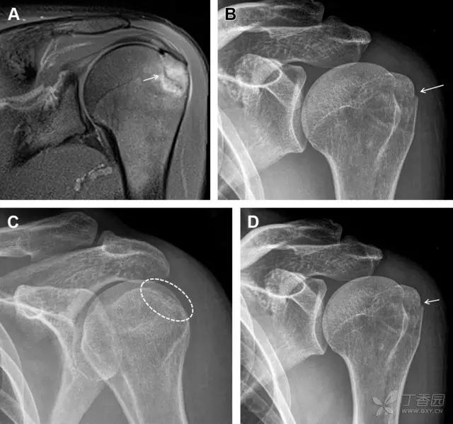 放射科夜班病例大全,放射科容易漏诊的骨折