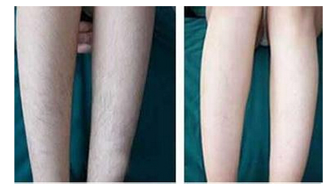 皮肤黑对脱毛效果有影响吗,脱毛后皮肤很黑怎么办