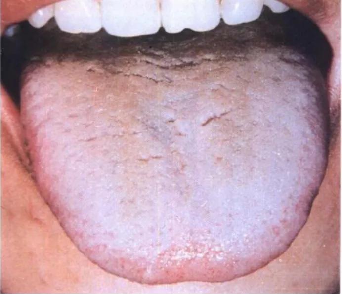 正确的舌诊图解及用药,感冒舌诊