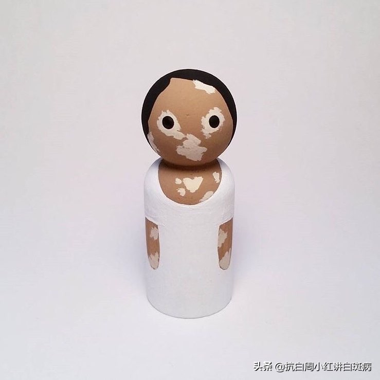 头上的白癜风大概多久可以康复,儿童白癜风好治吗怎么治疗