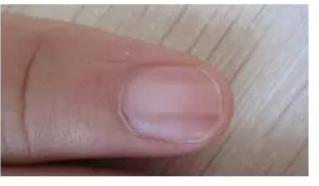 小小的指甲隐藏大大的健康秘密,小小指甲大调查