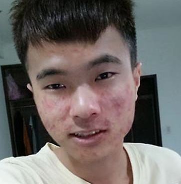 男生青春期爆痘用什么护肤品,青春期长痘男生如何护肤
