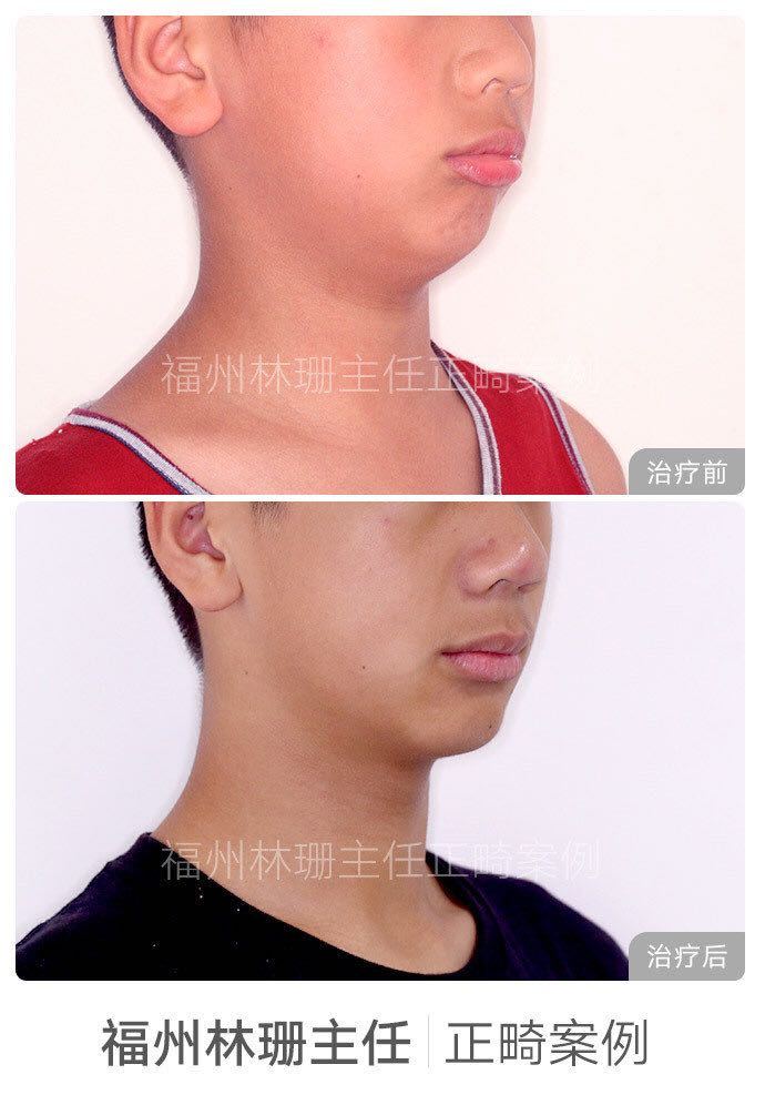 福州牙齿矫正林珊主任｜浅谈下颌后缩