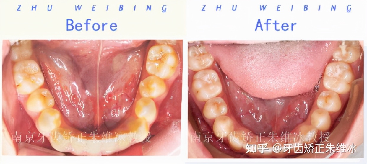 南京透明式牙齿矫正器地包天,18岁功能性地包天能改善面型吗