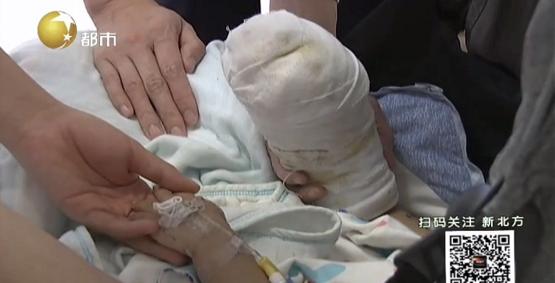 一岁宝宝被开水烫伤后皮肤发红,60度的水烫伤婴儿皮肤怎么办