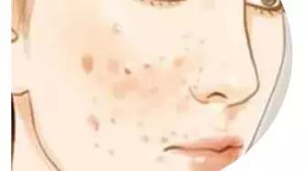 痘印反复冒痘怎么消除男生,痘印痘痘反反复复怎么办