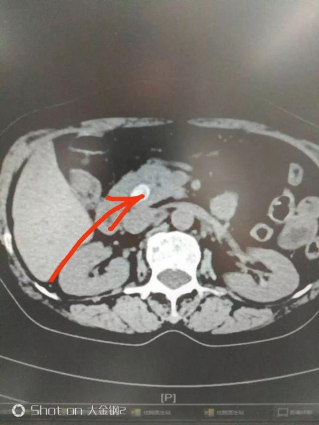 腹部手术完为什么要戴腹带,腹部手术之后为什么胀气