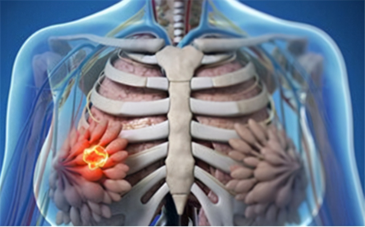 乳腺增生囊肿结节会癌变吗,乳腺囊肿乳房皮肤痒是癌变吗