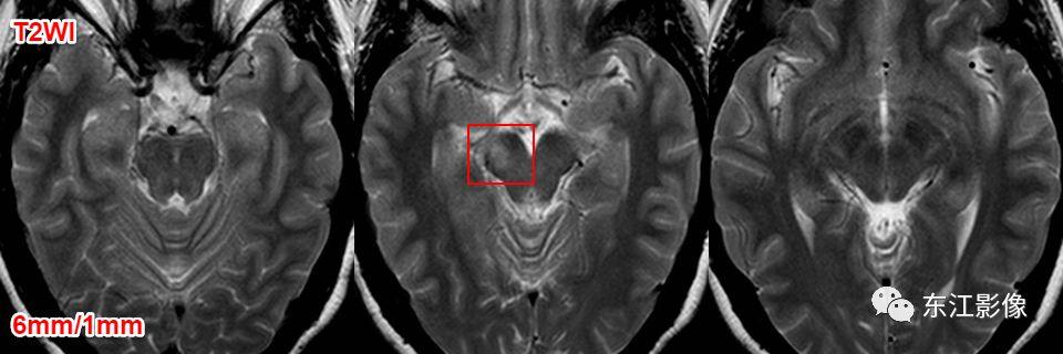 头颅mri扫描影像哪里找,头颅影像mra详细解说