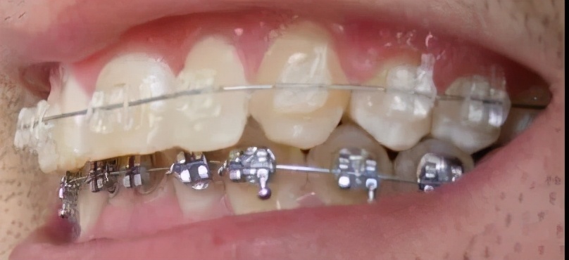 小心翼翼的我，还是把托槽弄掉了