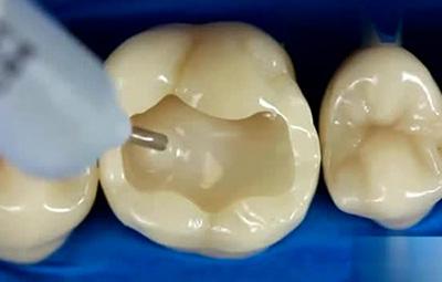 牙齿龋坏补牙能维持多久,牙齿龋坏比较严重补牙效果好吗