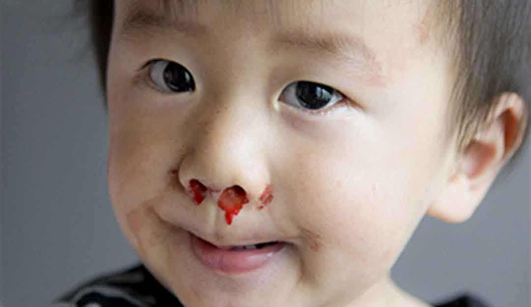 6岁男孩鼻子突然流血怎么回事,四岁男童夜里鼻子流血都干了